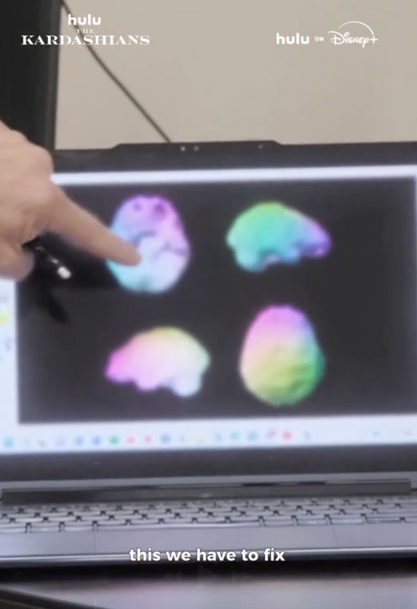 Kim Kardashian ma luki w mózgu