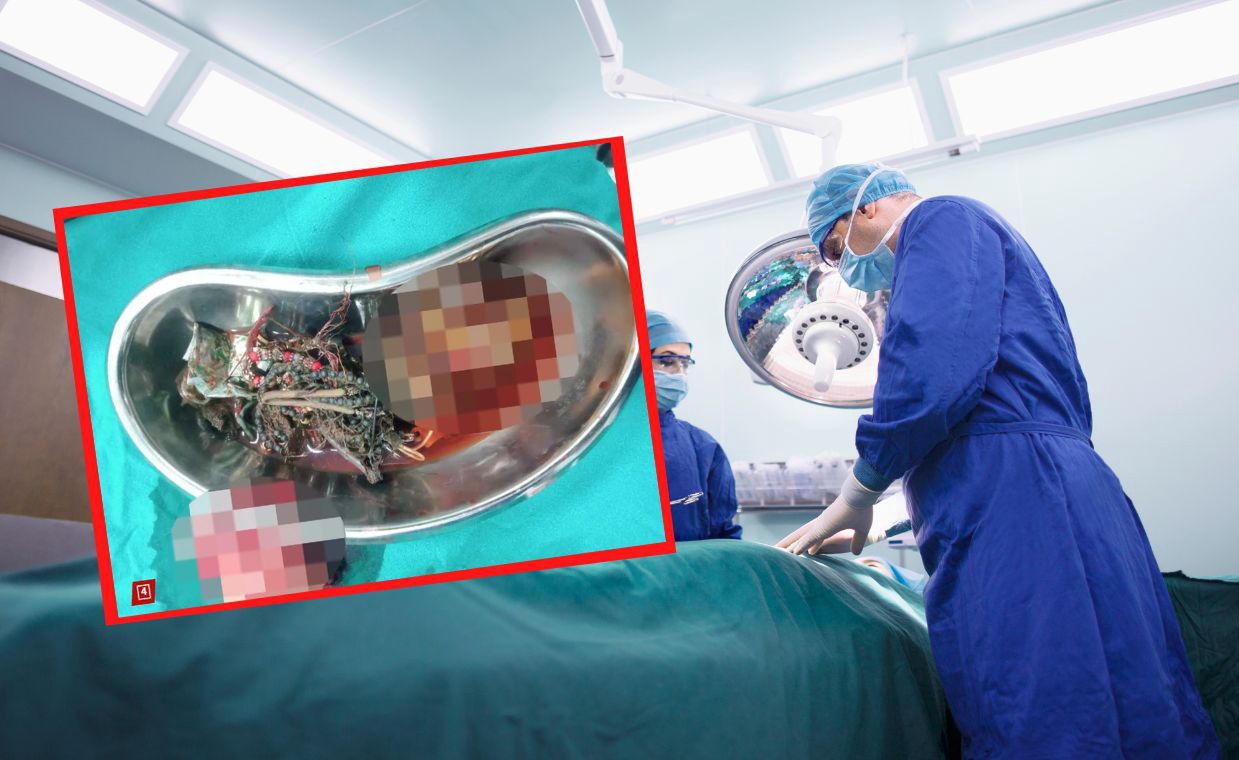 His stomach hurt. The doctors were stunned, found 60 objects inside