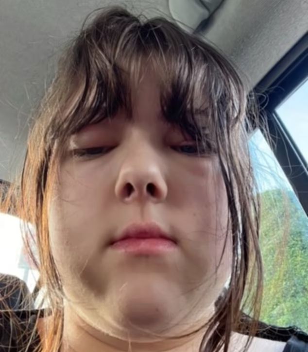 Bonnie pokazał się obrzęk na twarzy po COVID-19