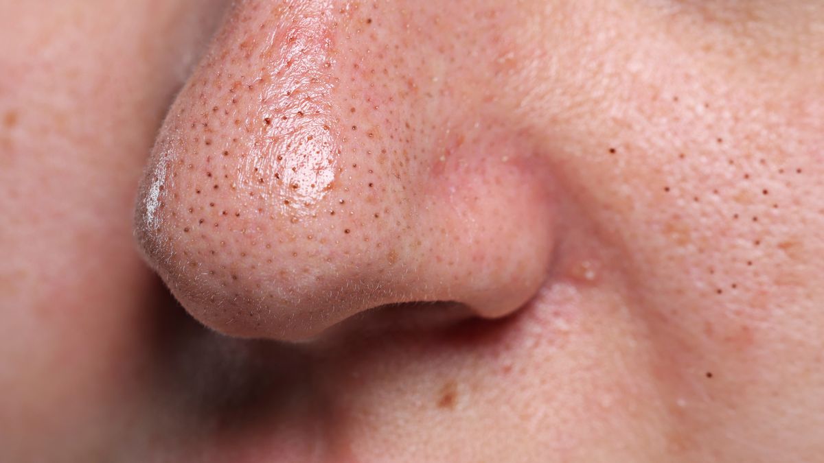 Wągry - jak z nimi walczyć?