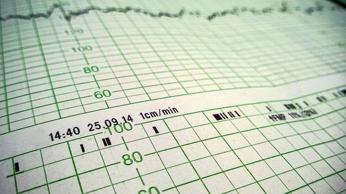 KTG płodu - charakterystyka badania