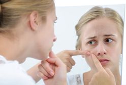 Sposoby na trądzik - kremy, peelingi i inne preparaty