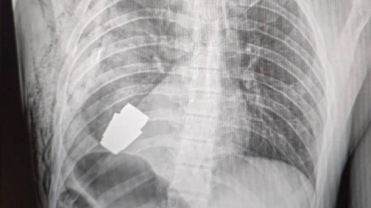 W ciele żołnierza utknął pocisk.