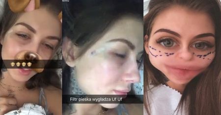 Deynn relacjonuje operację "usuwania worków pod oczami": "Jestem cała spuchnięta. WYGLĄDAM JAK PO BOTOKSIE!" (FOTO)