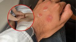 Tak stres i zła dieta wykańczają jelita. Objawy od razu widać na skórze