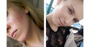 Całe życie walczyła z trądzikiem. Pokazała zdjęcia przed i po kuracji
