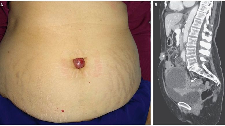 Niewielki guzek w pępku okazał się objawem zaawansowanego raka