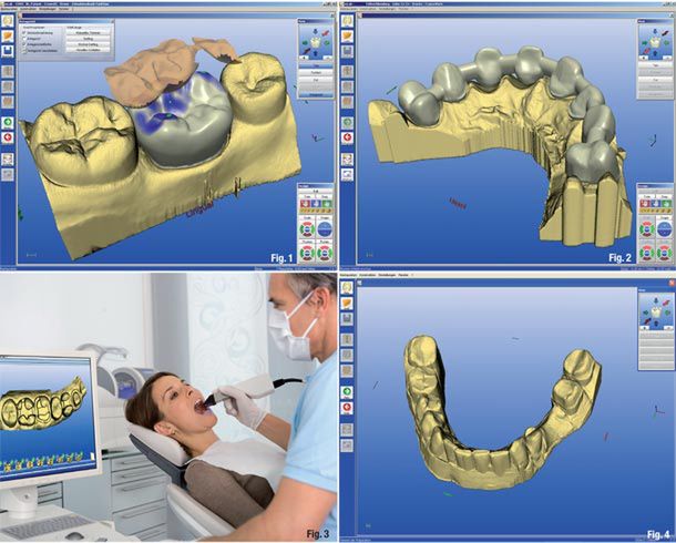 Użycie technologii CAD CAM - skaner do ust, program do modelowania na komputerze, drukarka 3D na zapleczu
