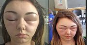 Alergia na farbę do włosów. Kobieta prawie oślepła