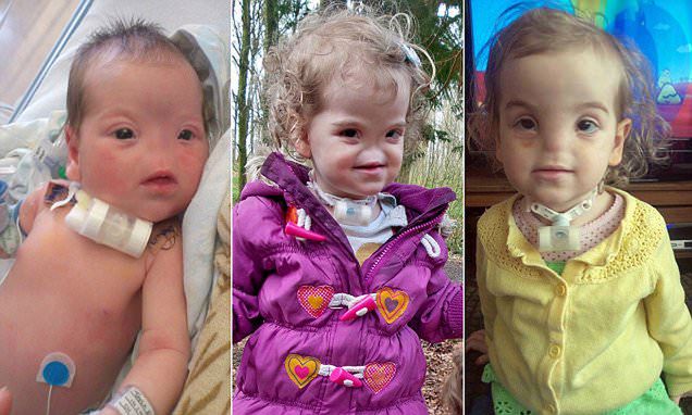 Tessa Evans urodziła się bez nosa. Dziś ma 6 lat