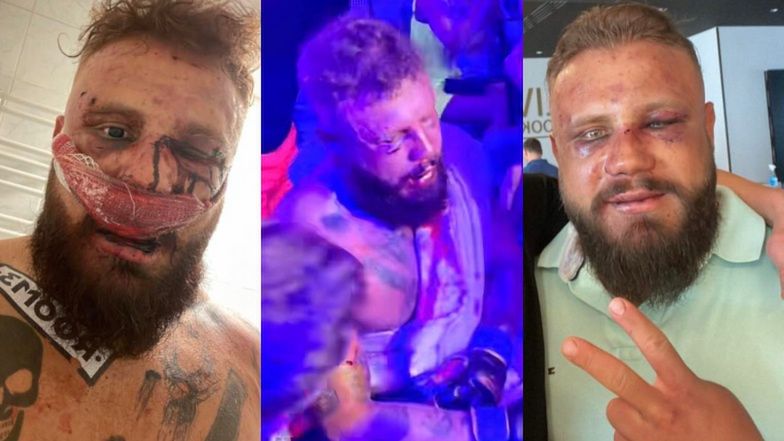 Arnold Jabłoński prezentuje poobijaną twarz po walce z Kubą Wójcikiem
