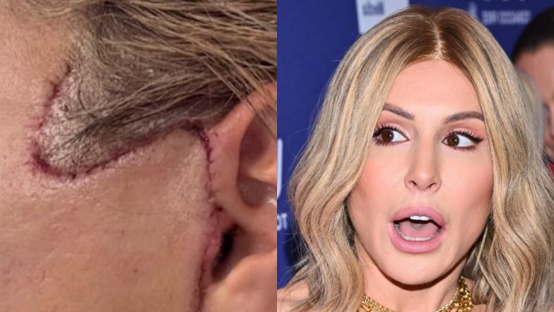 Blanka Lipińska pokazała blizny po liftingu twarzy