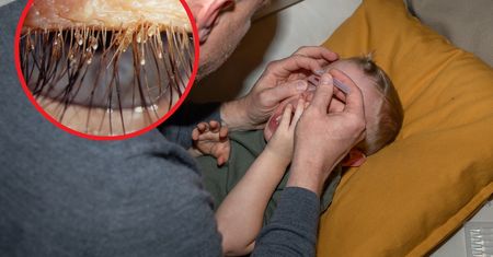 5-latka wciąż swędziały oczy. Pasożytami zaraził się w hotelu