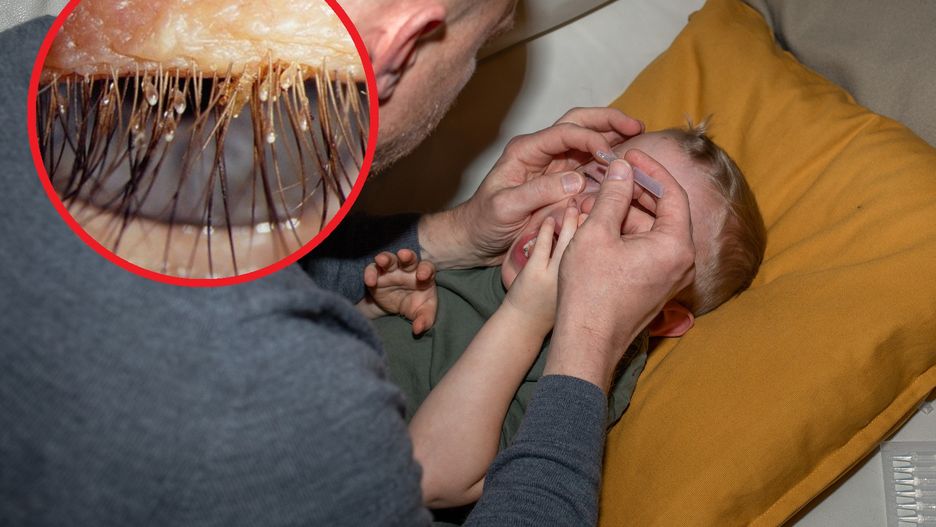 Chłopca swędziały oczy. Na powiekach i brwiach wykryto u niego jaja wszy