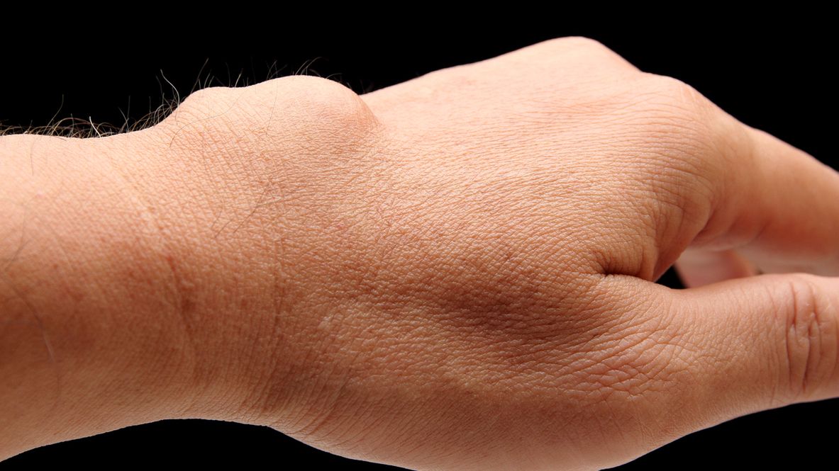 Ganglion ma postać guzka, który najczęściej zlokalizowany jest w okolicy nagdarstka.