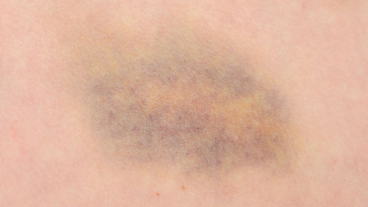 Zespół hemofagocytarny objawia się skłonnością do krwawień oraz łatwym siniaczeniem.