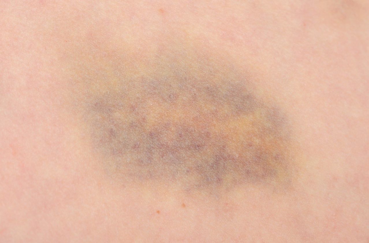 Zespół hemofagocytarny – przyczyny, objawy, rozpoznanie i leczenie