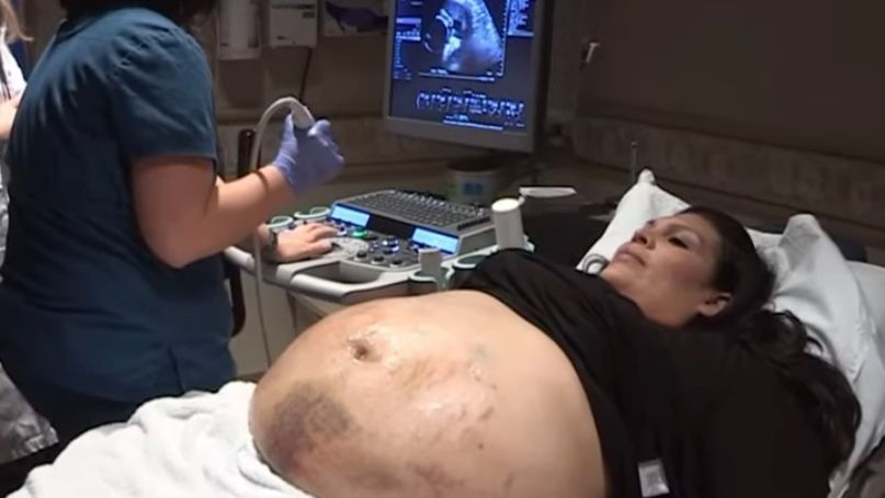 Jej brzuch pokrywały siniaki. Okazało się, że to przez to, że nosi pieciąraczki