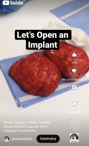 Pokazali, jak wygląda 10-letni implant piersi