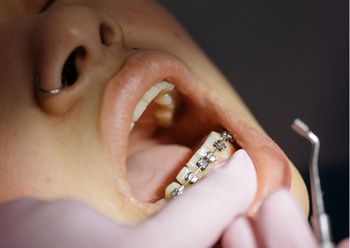 Wizyta u ortodonty może zrujnować domowy budżet. To jednak inwestycja w zdrowie