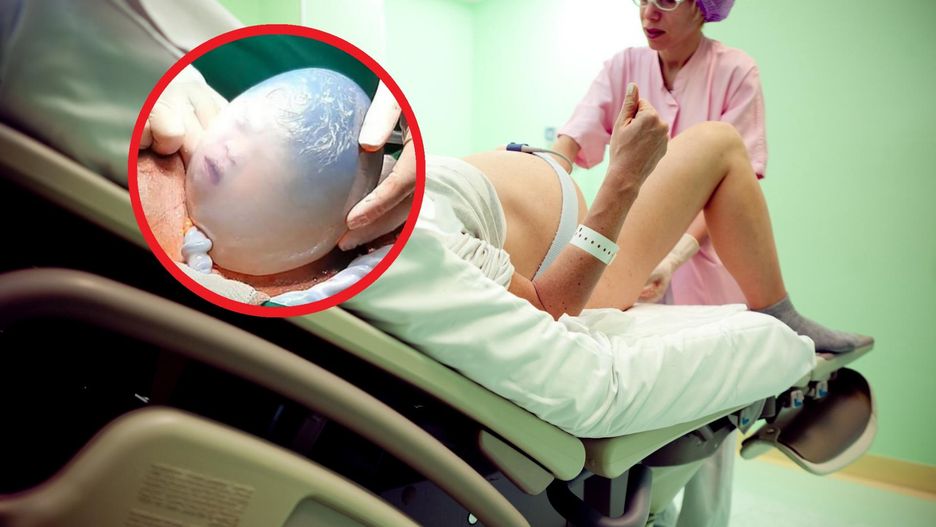 Niezwykłe narodziny bliźniąt. Lekarze byli w szoku