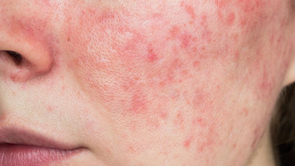 Demodeciodoza jest chorobą skóry wywoływaną przez nużeńce.