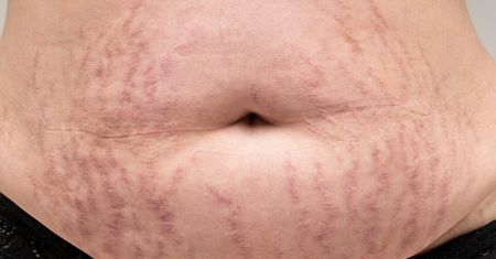 Masz takie blizny na brzuchu? Tak może się objawiać choroba hormonalna