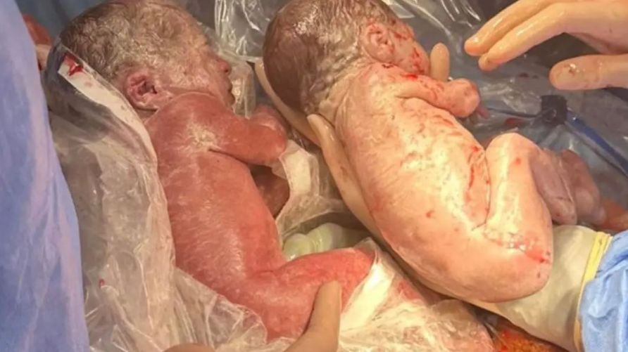 Bliźnięta o rożnym kolorze skóry