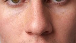 Mężczyźni chorują dwa razy częściej. Rak nosa trudny do wykrycia