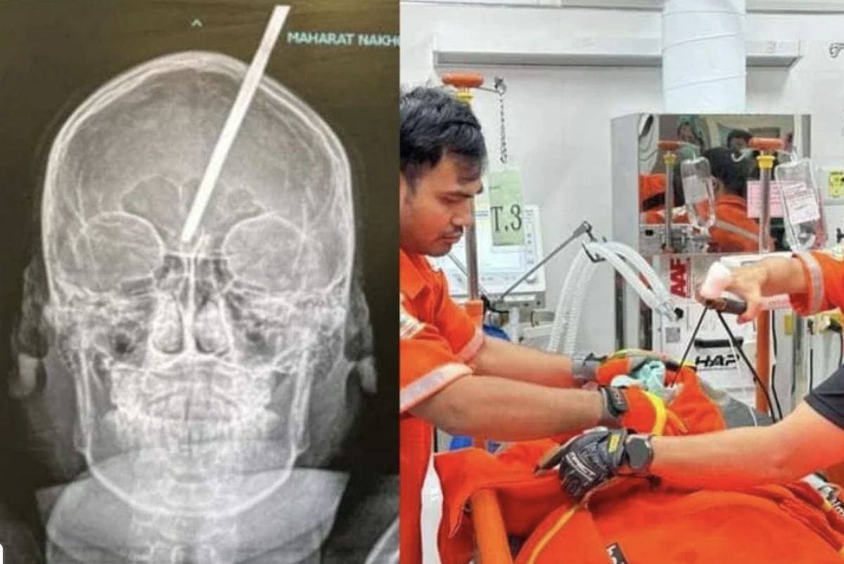 14-letni chłopiec z Tajlandii uratowany po tym, jak harpun przebił mu głowę, wbijając się do mózgu