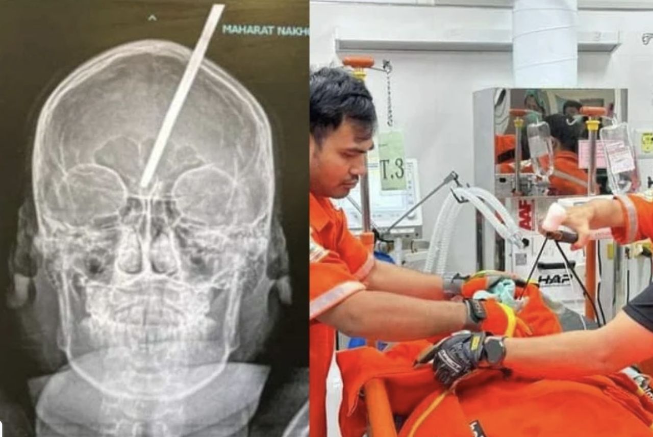 A 14-year-old boy from Thailand was rescued after a harpoon pierced his head, embedding itself in his brain.
