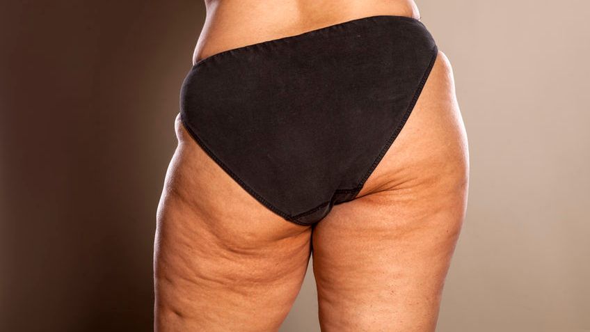 Cellulit, czyli grudki i nierówności na skórze przypominające skórki pomarańczy to problem wielu kobiet.