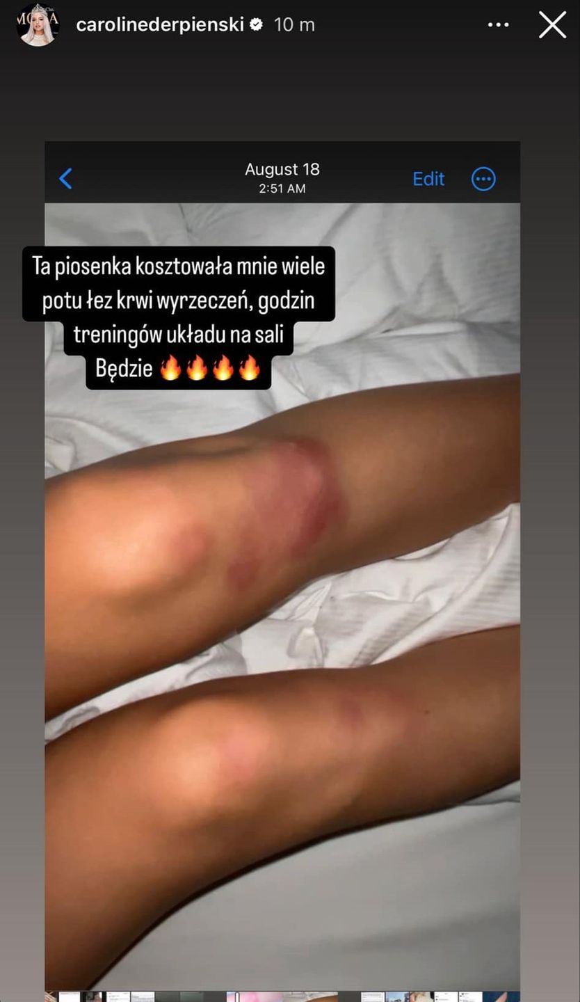 Posiniaczona Caroline Derpienski zapowiada nową piosenkę