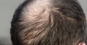 Łysienie androgenowe – przyczyny, objawy i leczenie