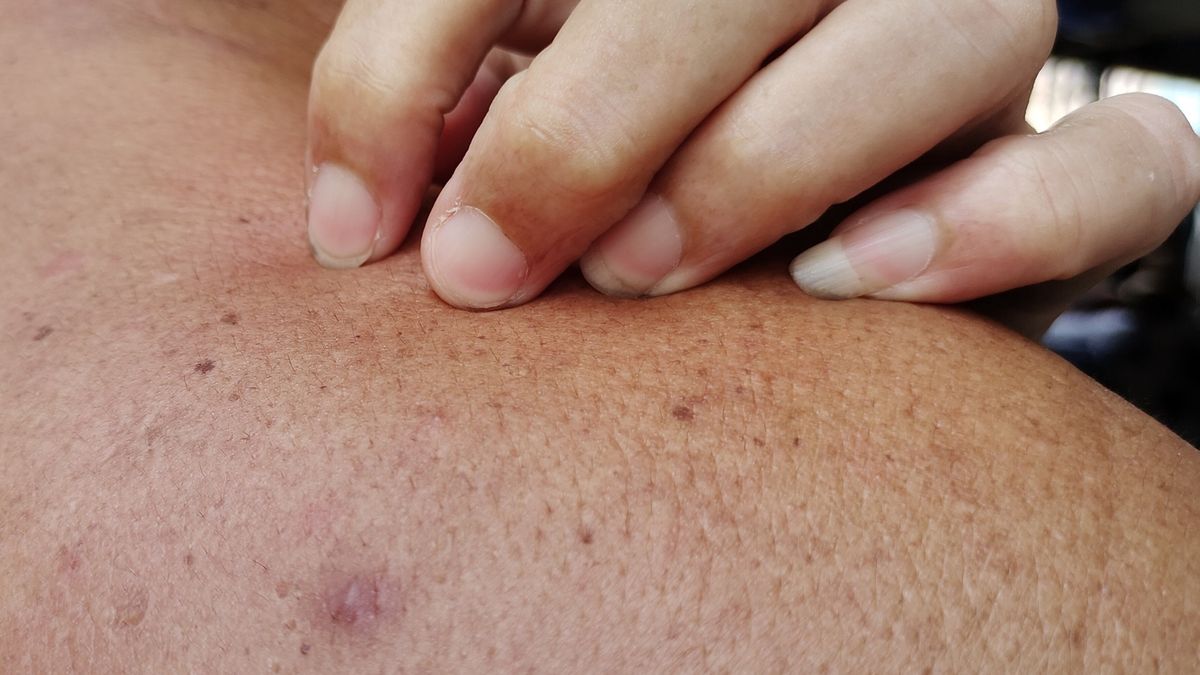 Dryness skin infections, allergic reactions and rash on the body.
Portrait showing dryness skin infections, allergic reactions and rash on the body, problem blemish and acne skin, scratch itchy of the male patient, concept health care.
Rungrudee