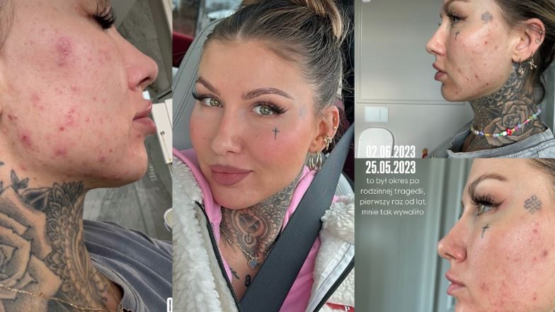 Deynn walczyła z trądzikiem.