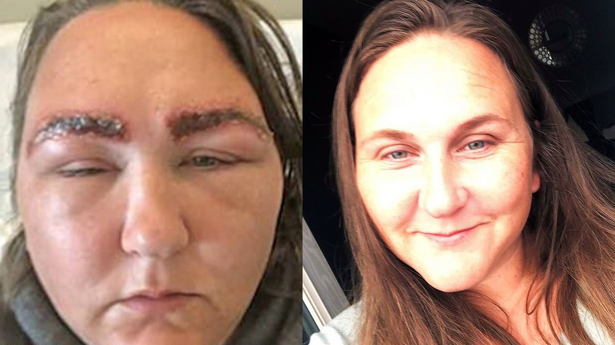 Nicole poparzyła farba do włosów