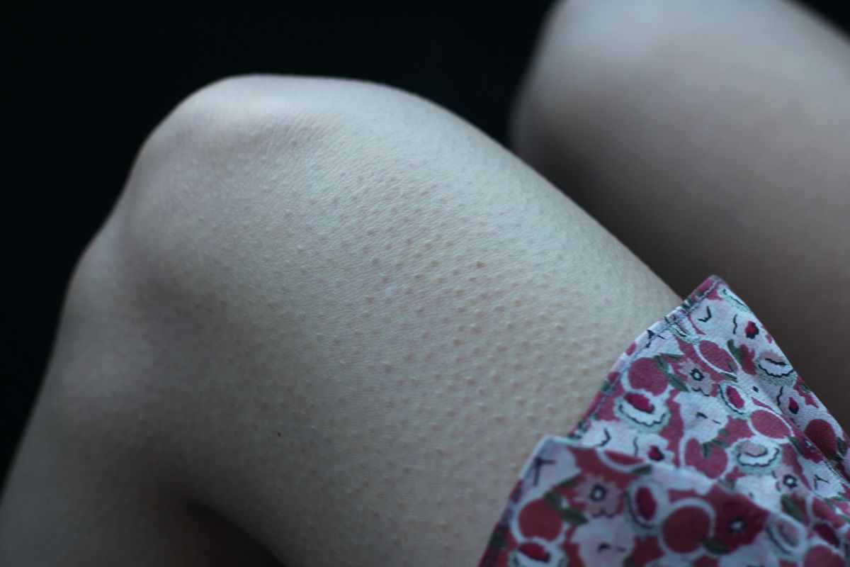 Gęsia skórka na ciele czasem pojawia się znikąd. Fot. Getty Images