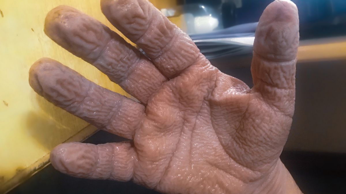Nadmiernie pomarszczona skóra na dłoniach może być objawem wodnej keratodermii