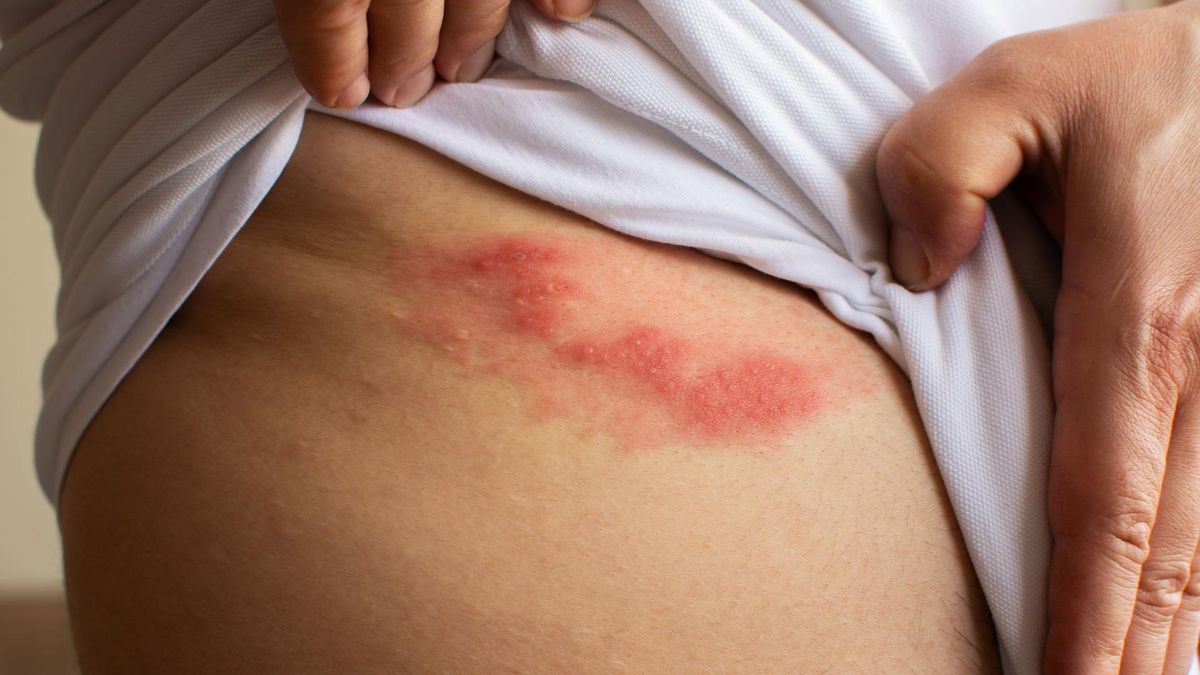 Półpasiec atakuje osoby, które wcześniej chorowały na ospę wietrzną.