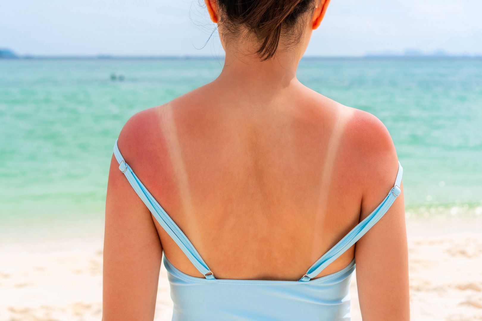 beach, sunburn, summer, skin, damage, red, burn, outdoors, back, sunbathing, sea, swimsuit, ultraviolet, body, adult, background, bikini, cancer, care, dermatology, female, girl, heat, holiday, hot, hurt, painful, people, person, problem, redness, shoulder, sun, sunny, suntan, surfer, tan, tanned, uv, vacation, water, woman, young