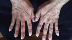 Paznokcie mogą zdradzić raka. Nie lekceważ charakterystycznego objawu