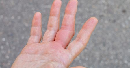 Pojawia się na dłoniach. To objaw chorej wątroby, ostrzega przed jej stłuszczeniem