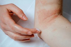 Koronawirus groźny dla chorych cierpiących na atopowe zapalenie skóry (AZS)