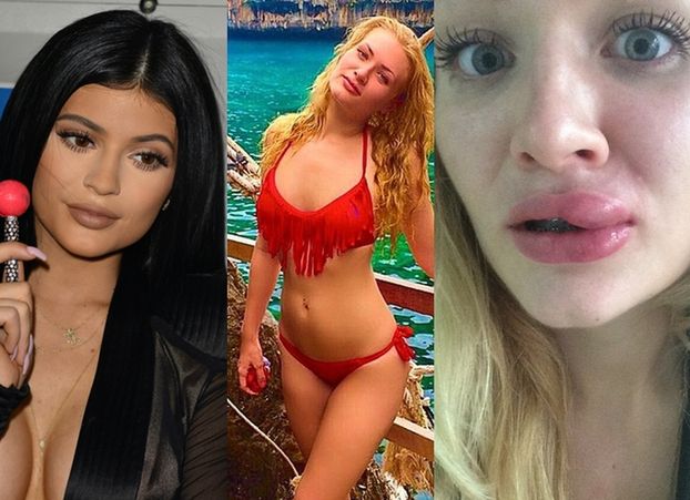 24-latka chciała mieć usta jak Kylie Jenner. Skończyło się tak!