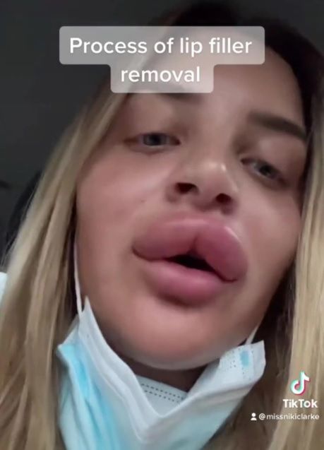 Po usunięciu wypełniaczy spuchły jej usta