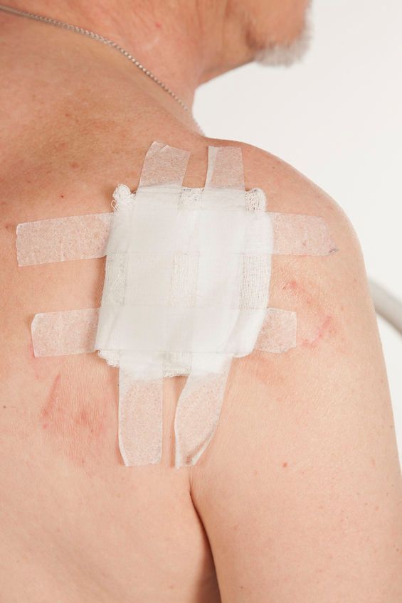 Zmiany na skórze mogą prognozować zachorowanie na inne nowotwory