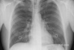 Koronawirus. USG płuc pozwoli poprawnie zdiagnozować COVID-19?