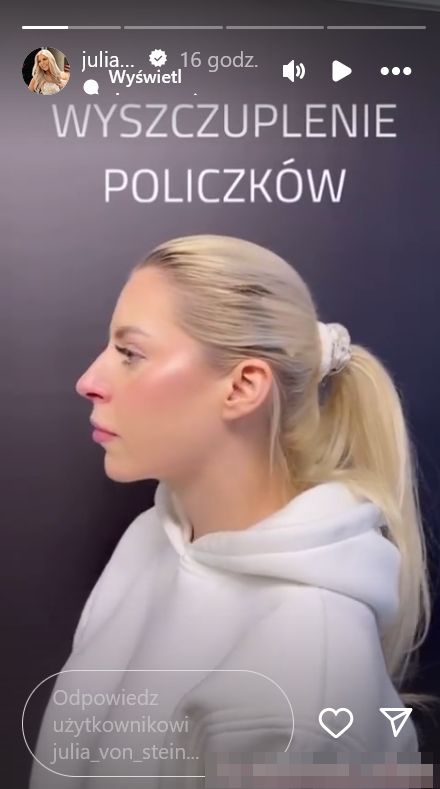 Julia von Stein chwali się nowymi rysami twarzy