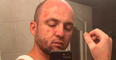 Łukasz Matusik opowiada o walce z łuszczycą i przypomina o swojej akcji #łuszczycaniezaraża